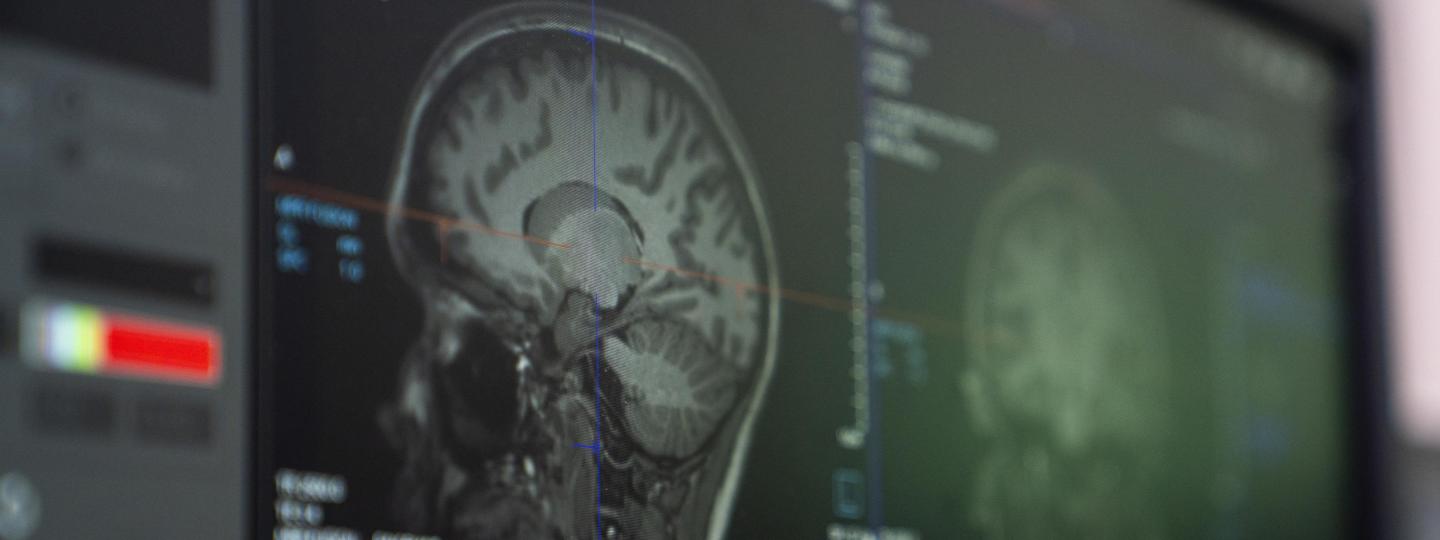 AN image or a brain from an M R I displays on a monitor.